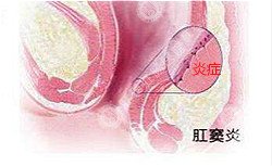 福州哪家肛肠医院治肛瘘好？